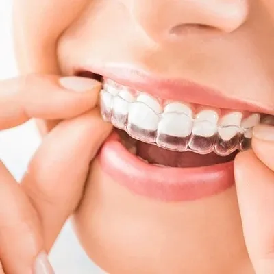 Dental Aligners