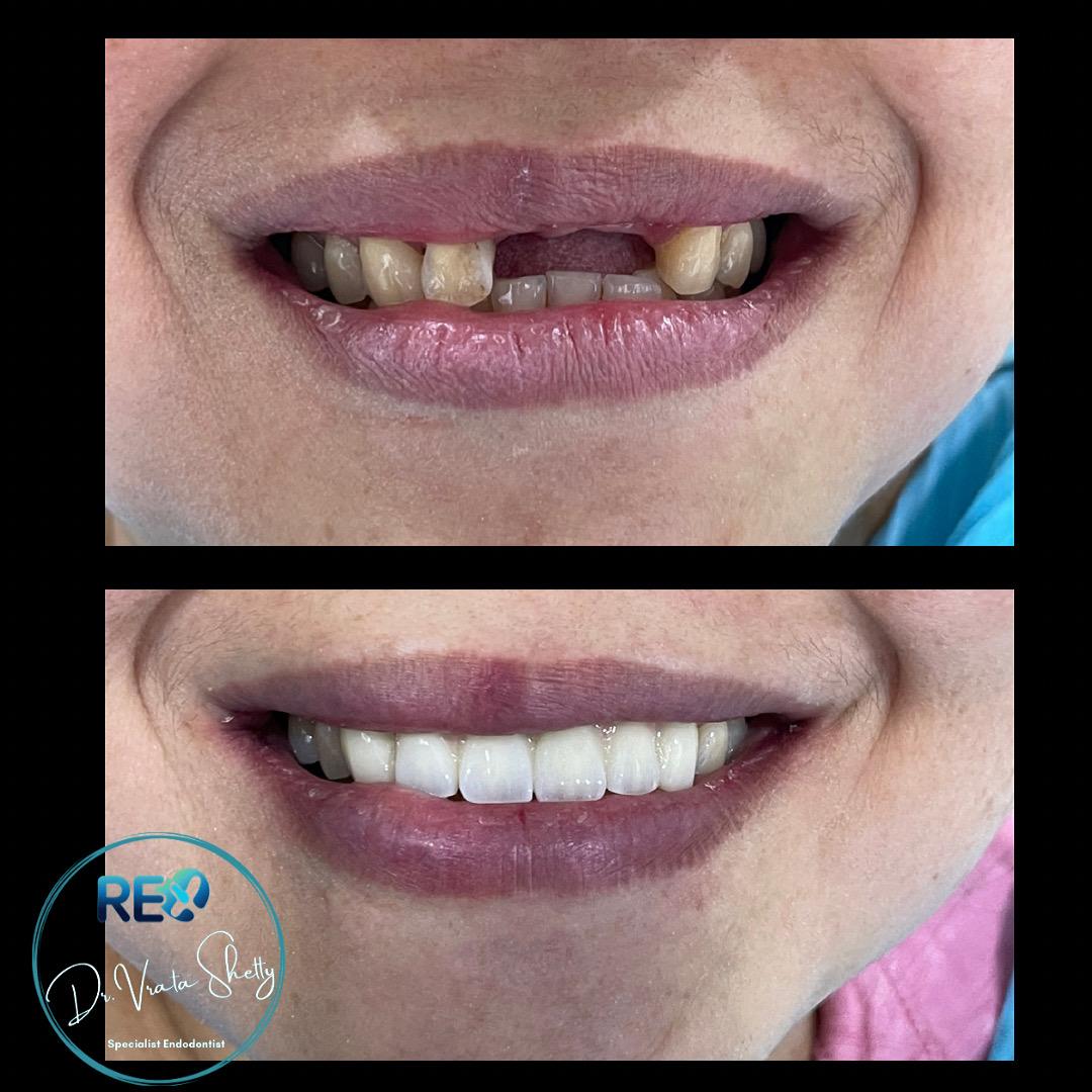 Types of Dental Implants