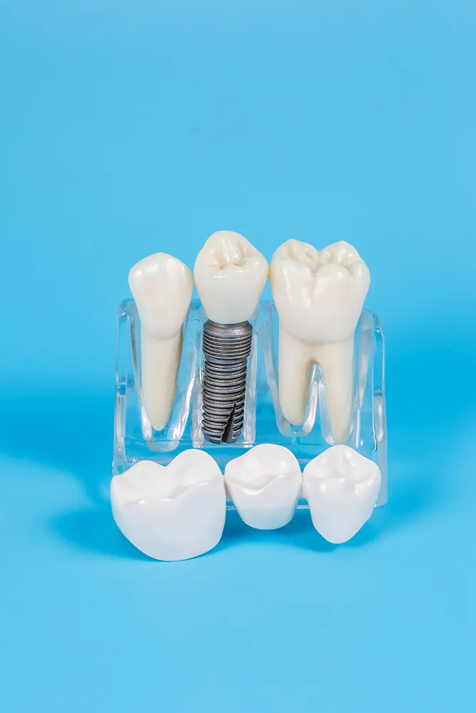 Dental Crown Treatment at Rex Medical Centre