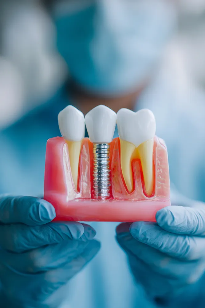 Dental Implant Consultation