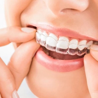 Beaming smile with invisible aligners in Dubai